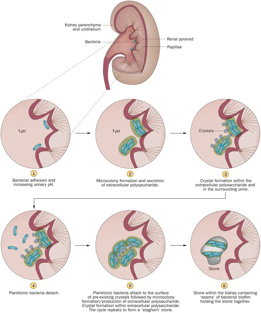 Formation Mechanism of Infection Stones (Struvite)