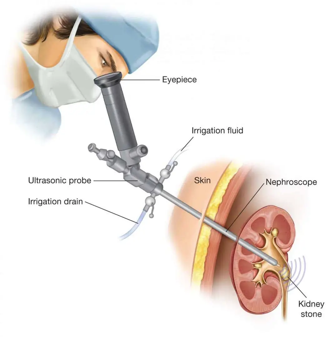 Percutaneous Nephrolithotomy (PCNL)