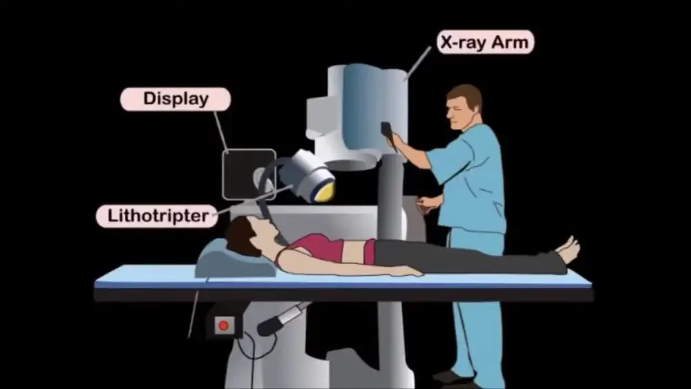 Extracorporeal Shock Wave Lithotripsy (ESWL) Detailed Guide