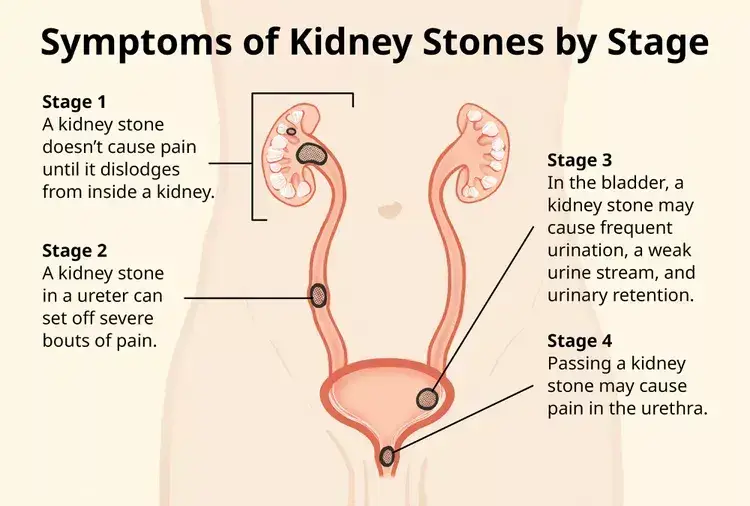 How to Relieve Pain from Kidney Stones