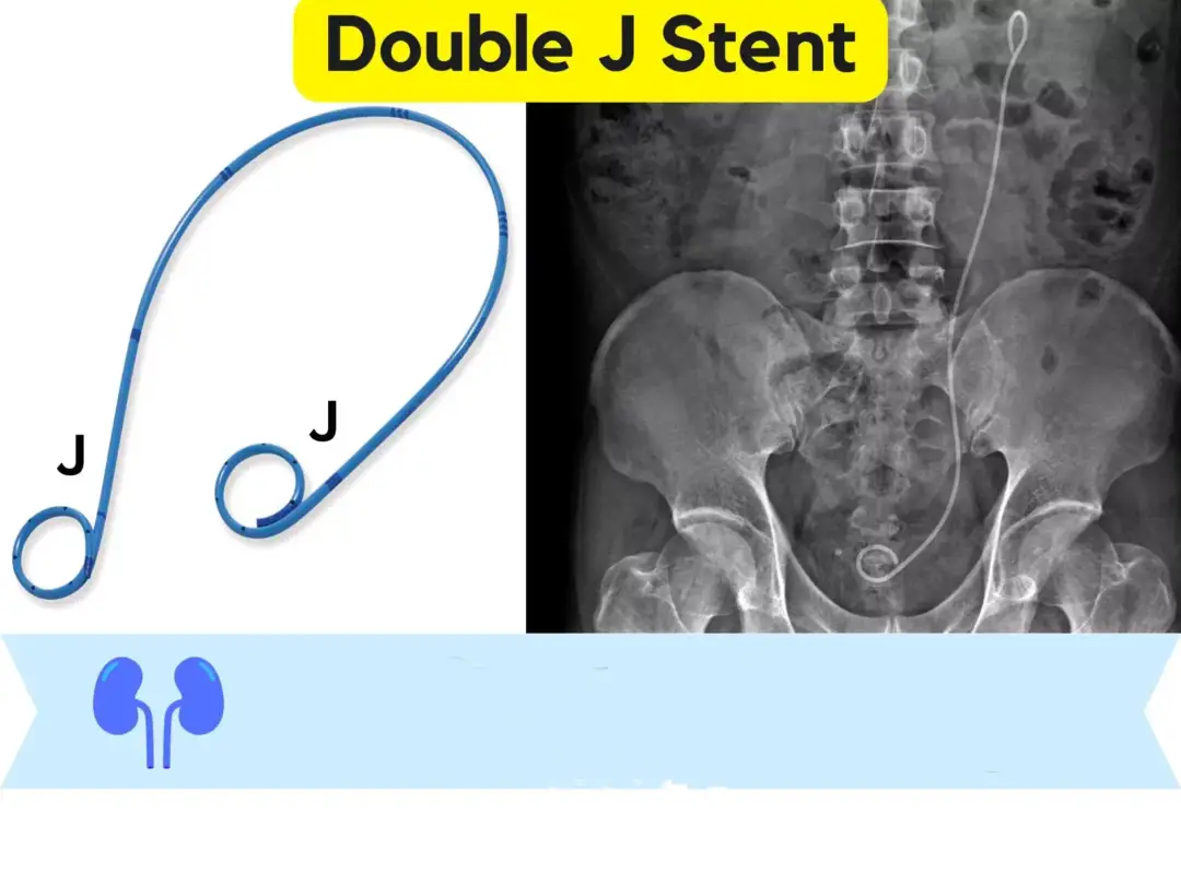 Double-J Stent Care After Kidney Stone Treatment