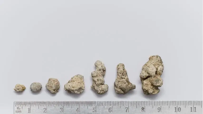 Initial Self-Identification Methods for Kidney Stones