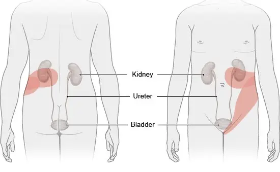 Kidney Stone Pain Characteristics and Location Changes