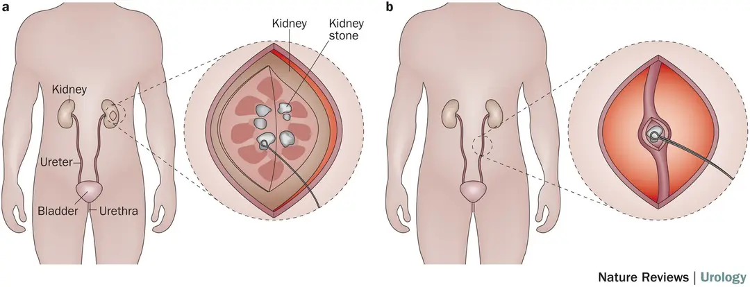 Open Surgery in Modern Kidney Stone Treatment
