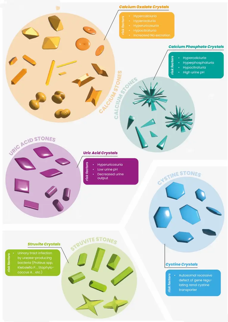 Calcium Phosphate Kidney Stones - Formation Mechanisms