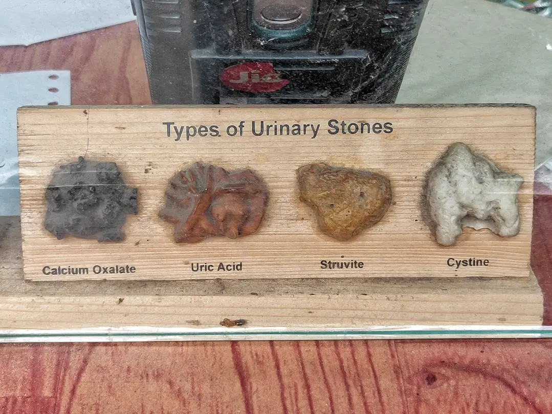 Four Main Types of Kidney Stones and Their Characteristics