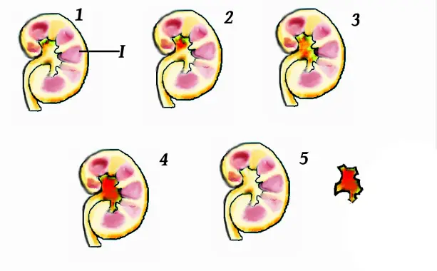 Formation Mechanism of Kidney Stones