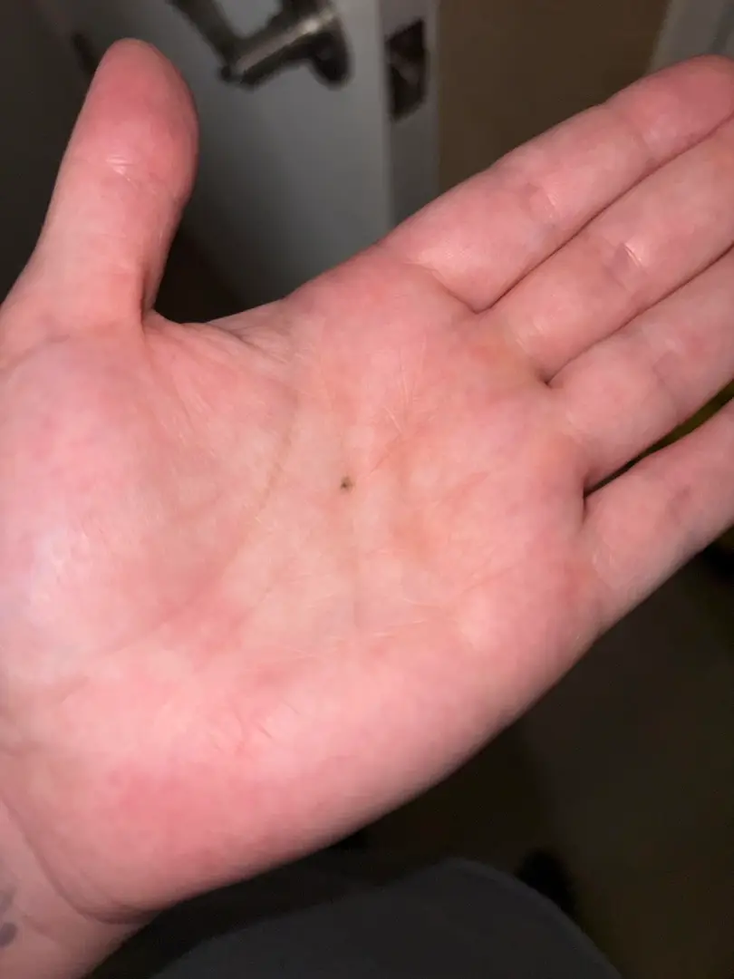 This LITTLE tiny stone caused the most excruciating pain of my life!!! — photo 2
