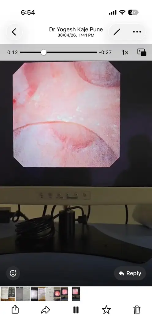 Recurrent Stone Formed. Surgery done twice in 2 years.. — photo 2