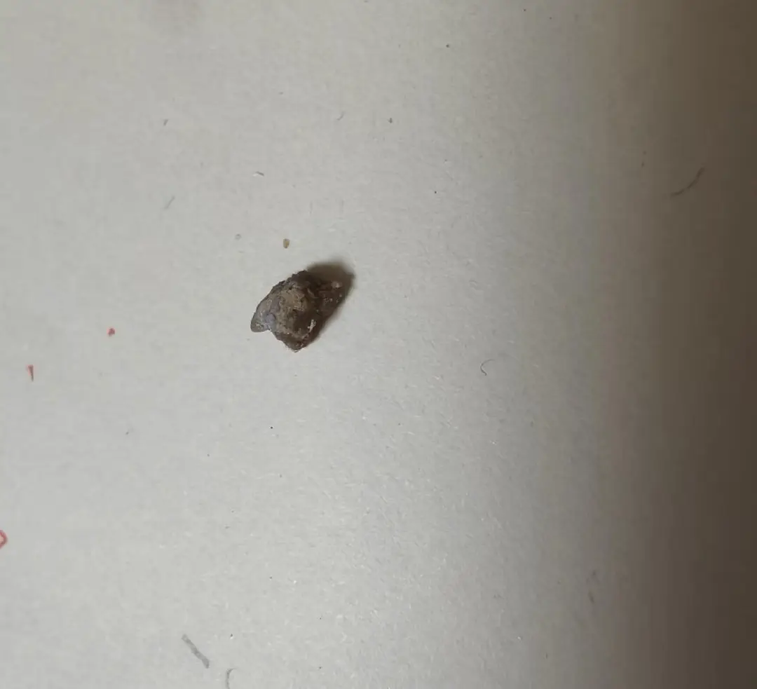 My 7mm kidney stone gave me the worst experience. — photo 1