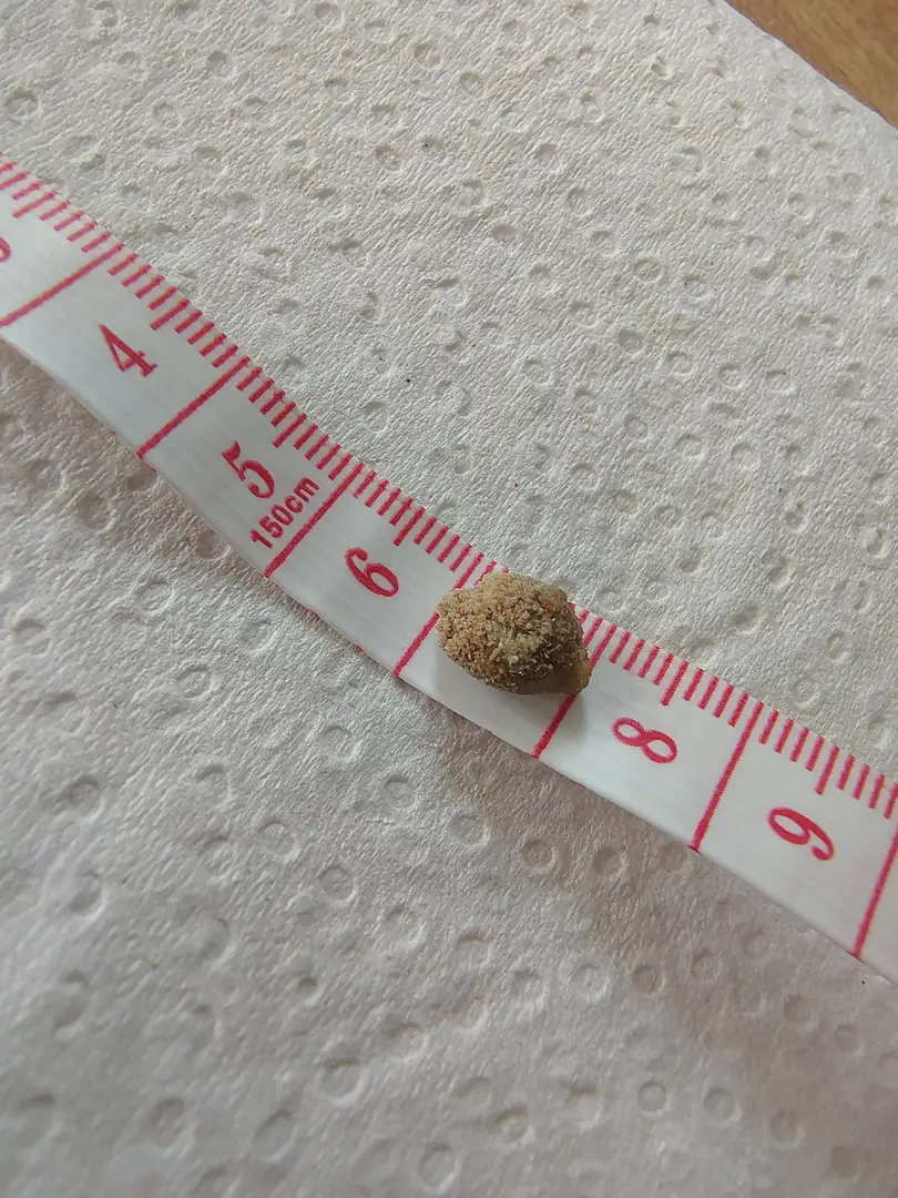 First (and hopefully last) kidney stone — photo 3