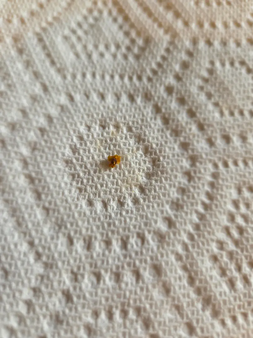 8th stone has been expelled! 3mm pokey ball of pain! — photo 1