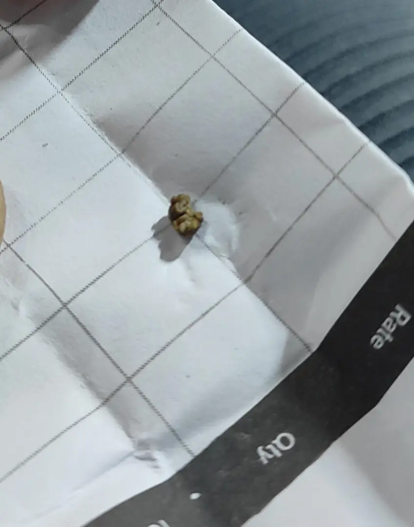 Finally passed this kidney stone today… but I've still got another one stuck in there. — photo 1