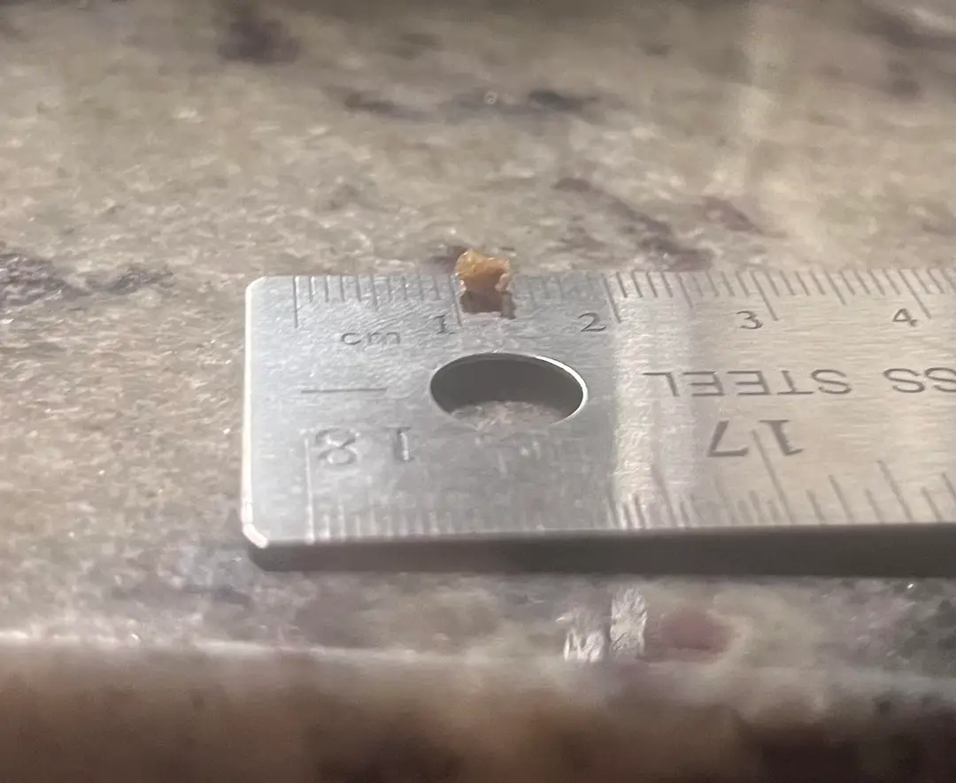Update on pain that continued after passing stone: surprise 2nd stone — photo 2