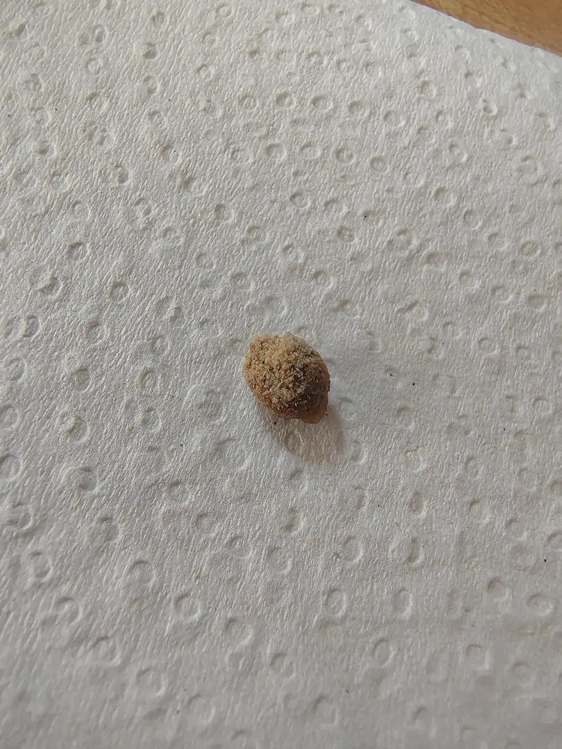 First (and hopefully last) kidney stone — photo 4