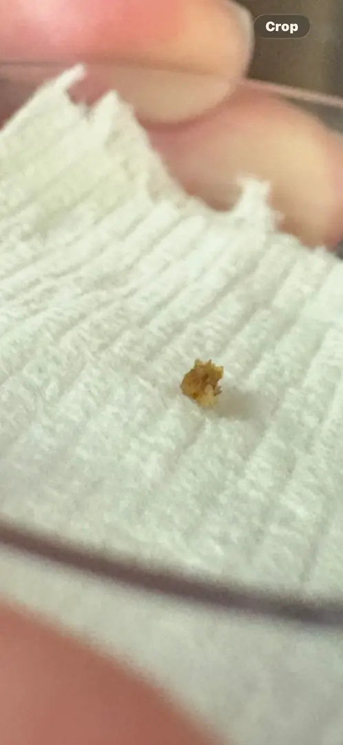 Finally passed this 4mm stone after nearly 3 months. — photo 2