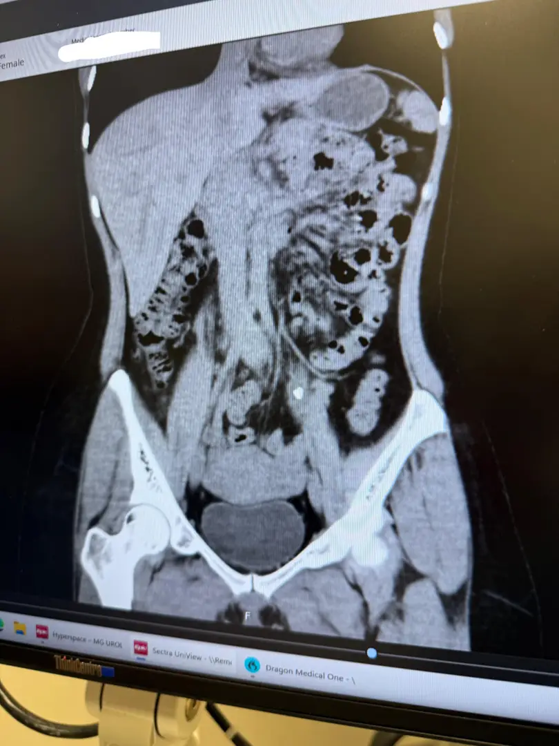 7mmx7mm stone/s on CT — photo 1