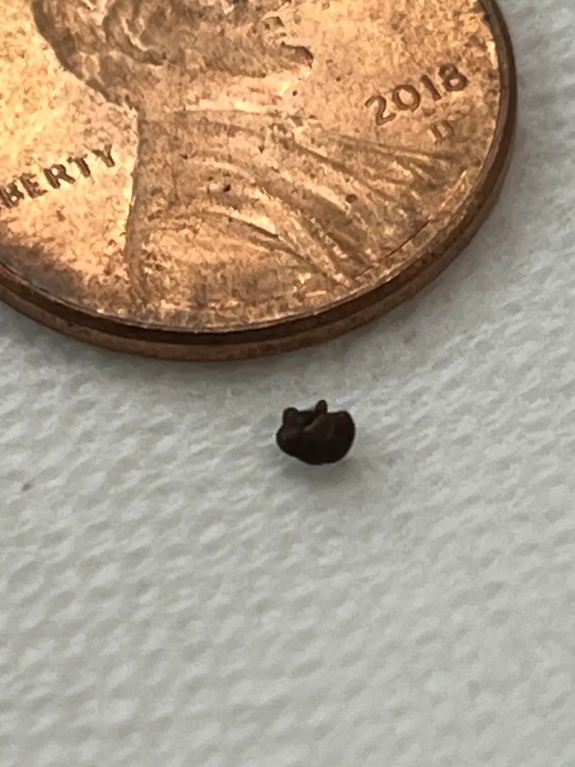 Woke up from a nap to 7/10 pain, went up to 10/10 that lasted 2 hours. So relieved it’s out of my body — photo 2
