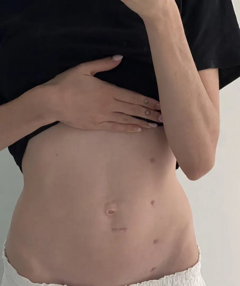 22mm stone ended in ureter reconstruction surgery — photo 1