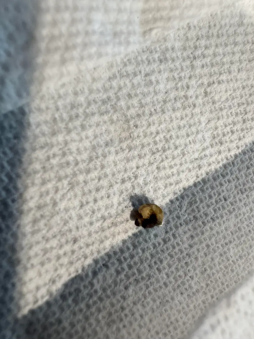 Can you identify type of kidney stone based on photo? — photo 3