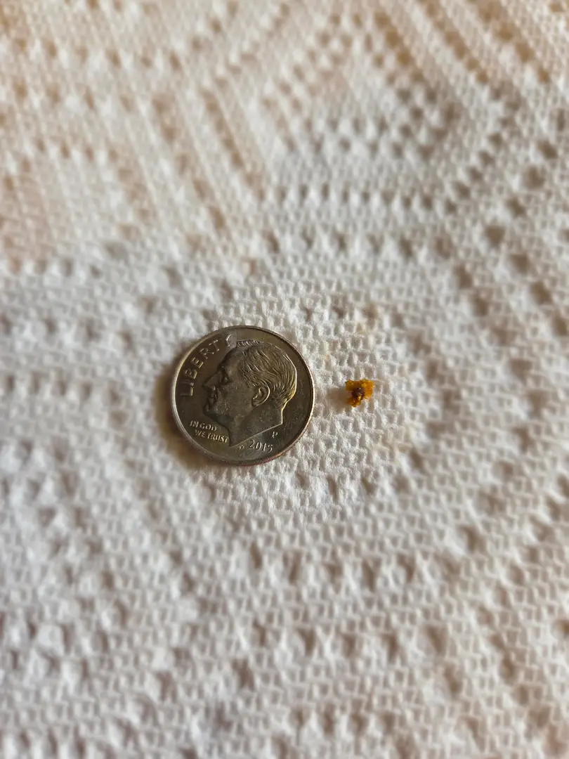 8th stone has been expelled! 3mm pokey ball of pain! — photo 2