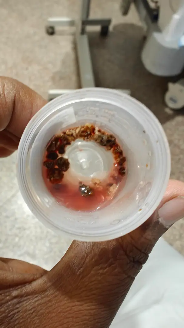 Had PCNL for my 22mm stone—now heading back for surgery again — photo 2