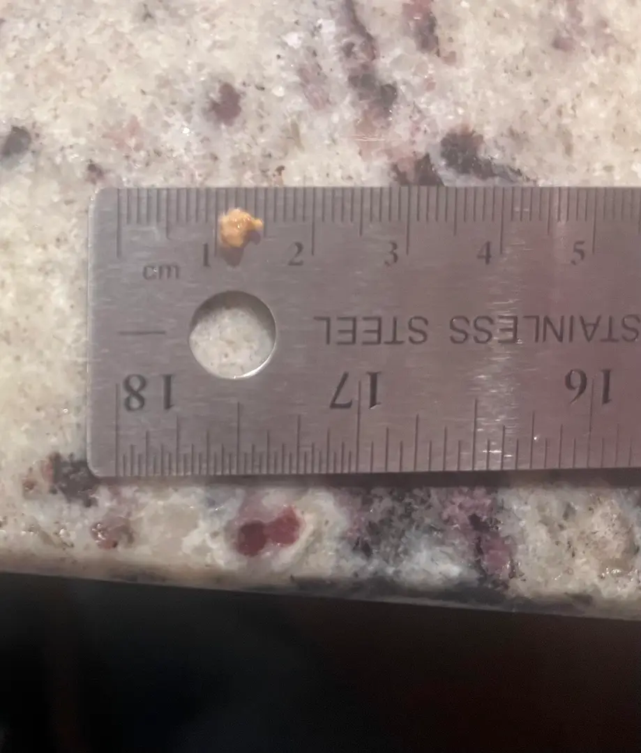 Update on pain that continued after passing stone: surprise 2nd stone — photo 1