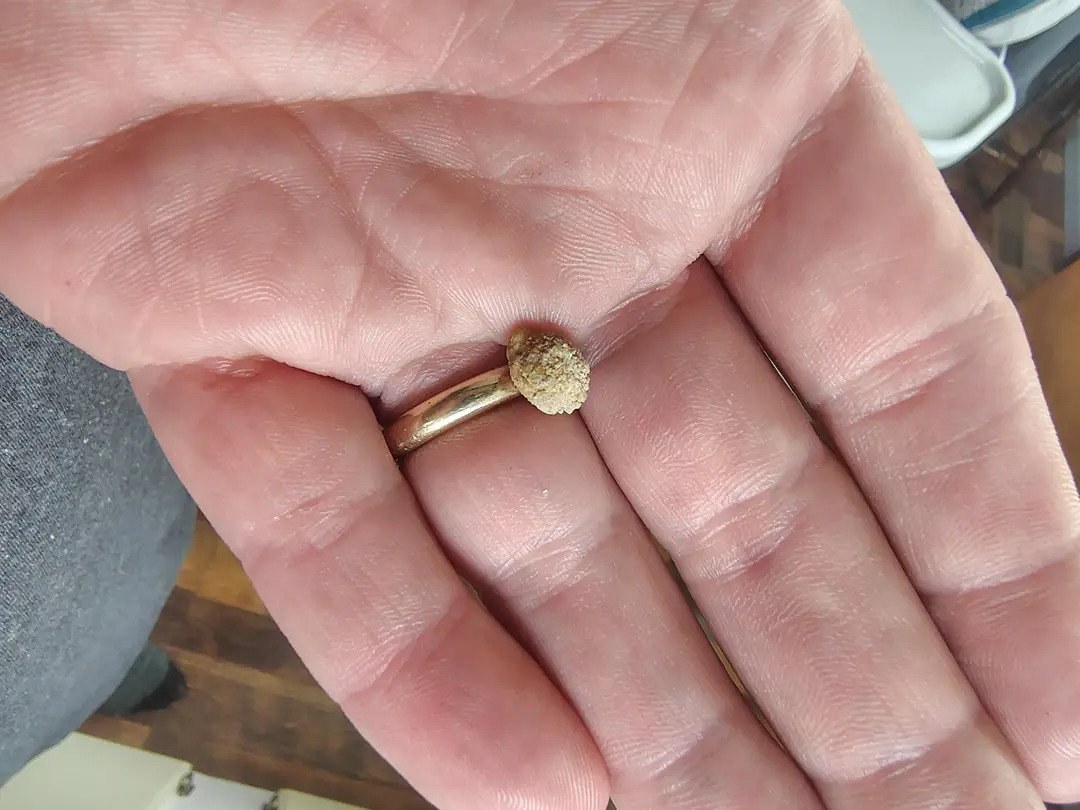 First (and hopefully last) kidney stone — photo 1