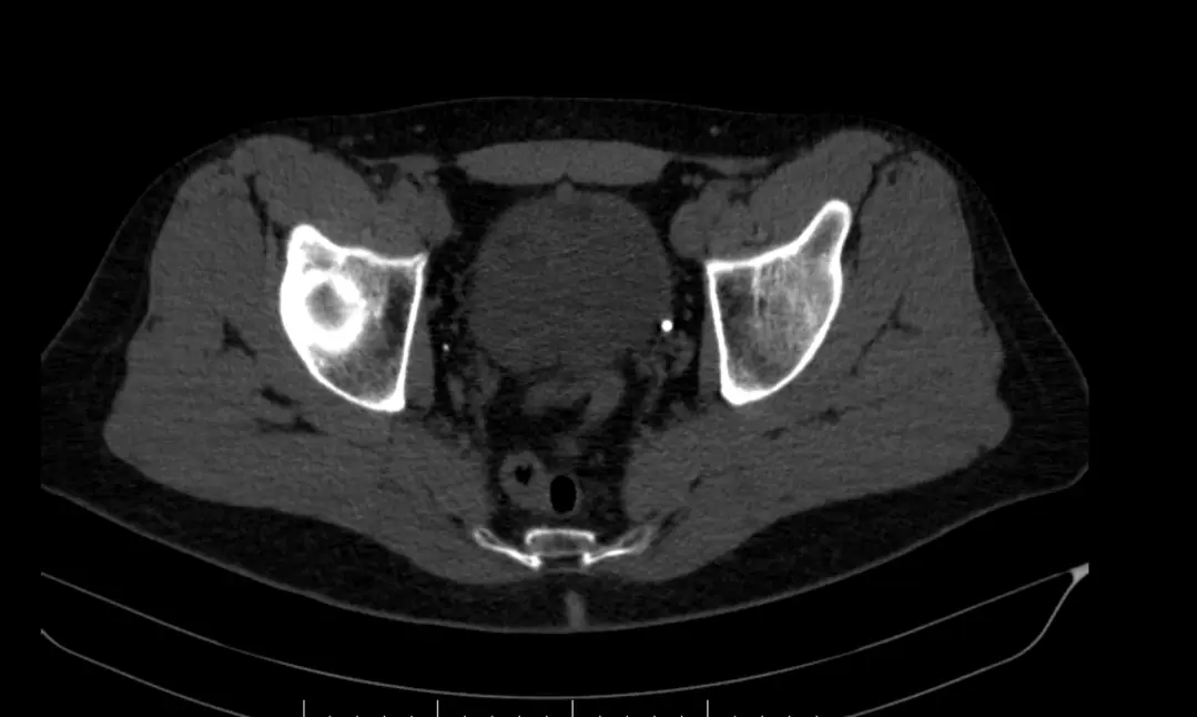 White spot near bladder on non-contrast uro-CT — stone or calcification? — photo 1