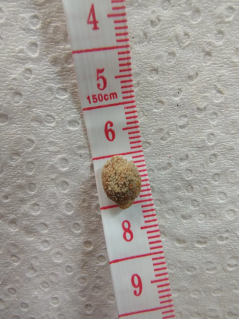 First (and hopefully last) kidney stone — photo 2