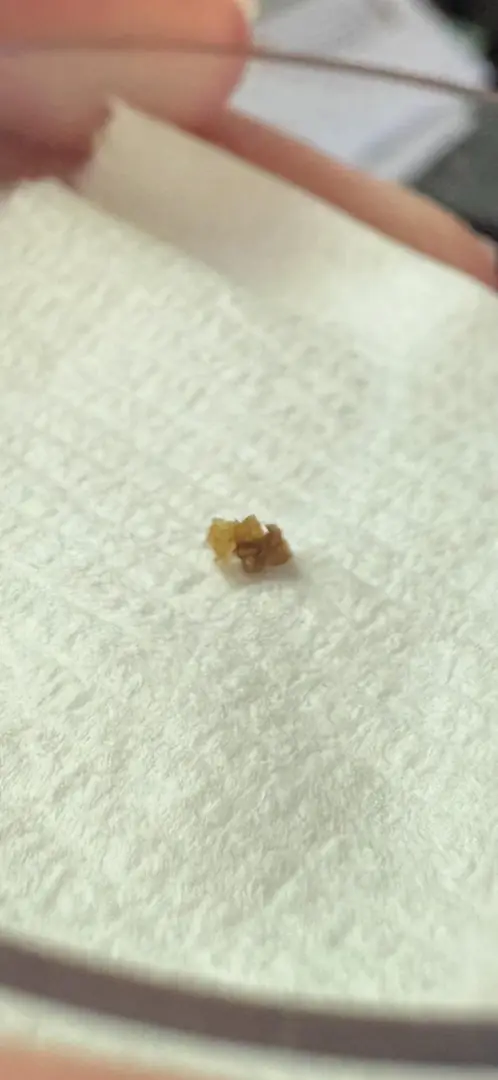 Finally passed this 4mm stone after nearly 3 months. — photo 3