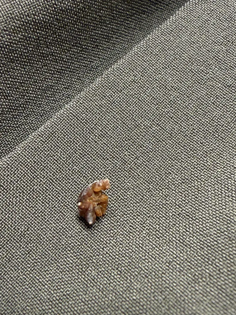 Did I just pass a kidney stone ? โ photo 1