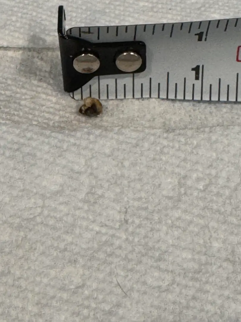 Can you identify type of kidney stone based on photo? — photo 2