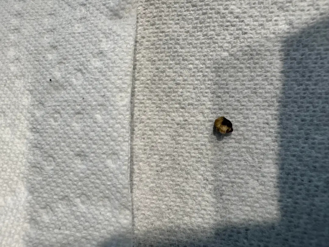 Can you identify type of kidney stone based on photo? — photo 1