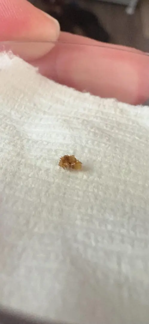 Finally passed this 4mm stone after nearly 3 months. — photo 1