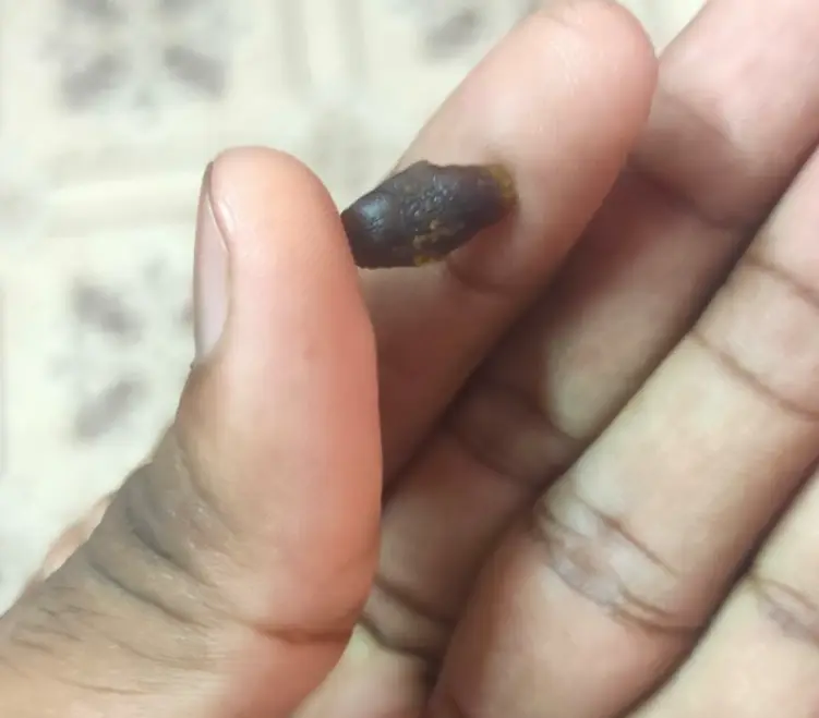 22 years of passing kidney stones and I’m still fighting! — photo 1