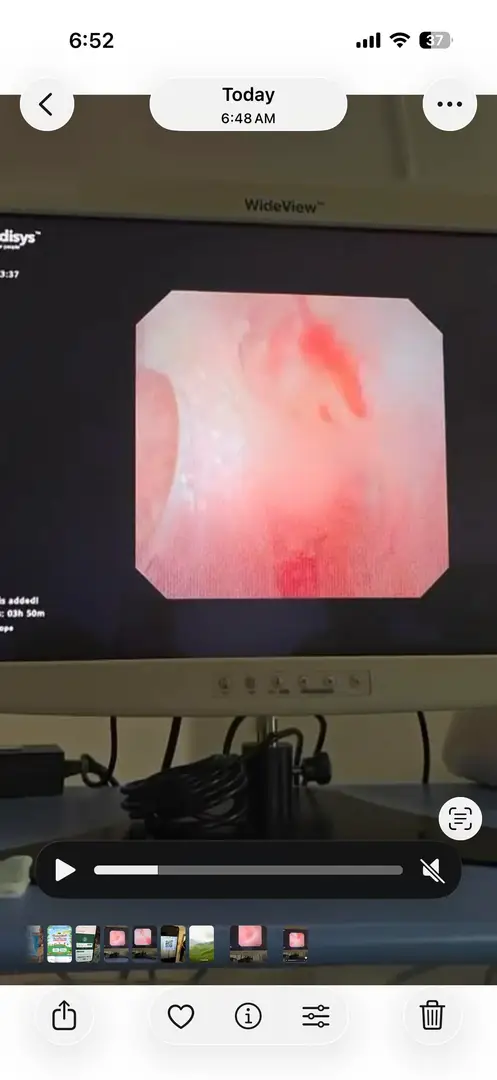 Recurrent Stone Formed. Surgery done twice in 2 years.. — photo 1