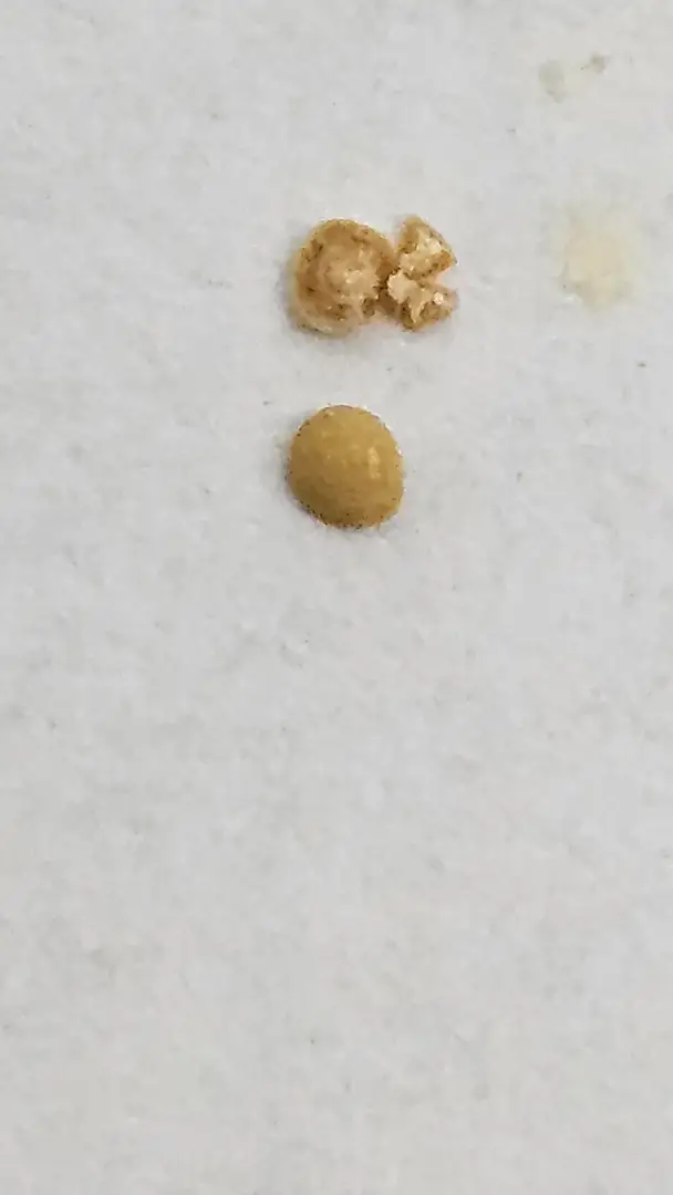 Kidney stone won't dissolve — photo 1