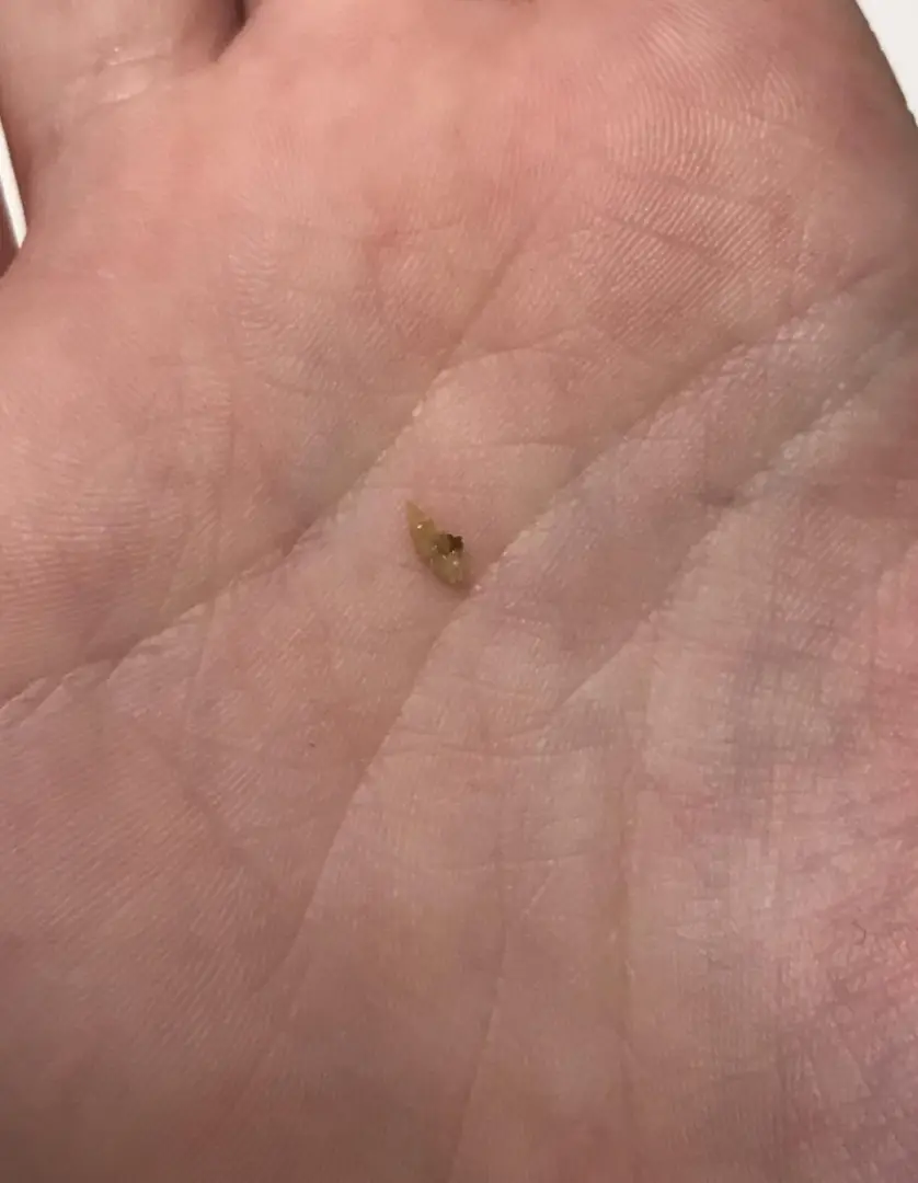 Recurring stones and my mental health — photo 1