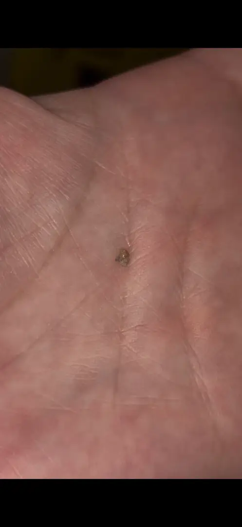 This LITTLE tiny stone caused the most excruciating pain of my life!!! — photo 1