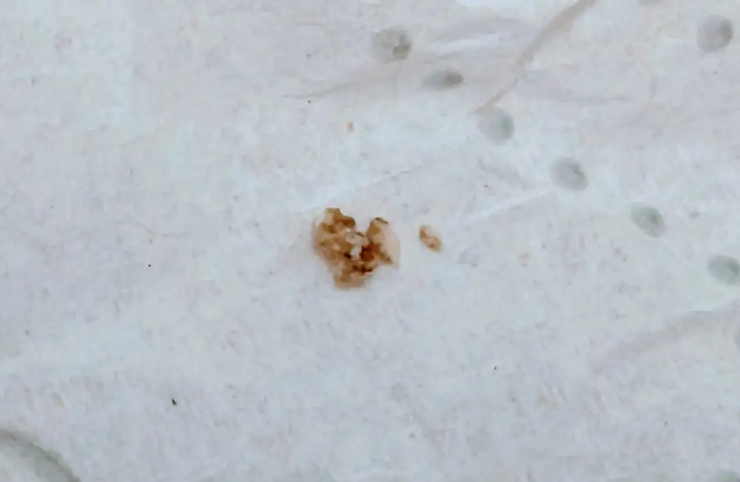 First Kidney Stone — photo 1