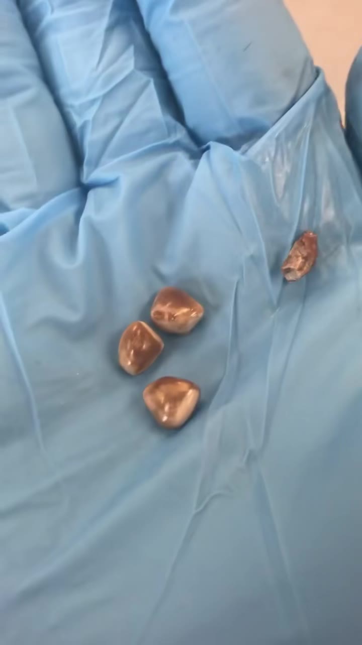 KIDNEY STONE SIZES They can also be pulverized