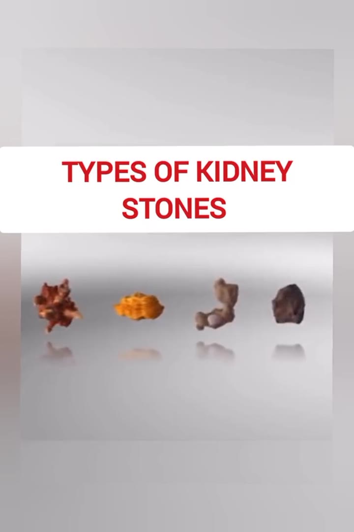 types of kidney stones
