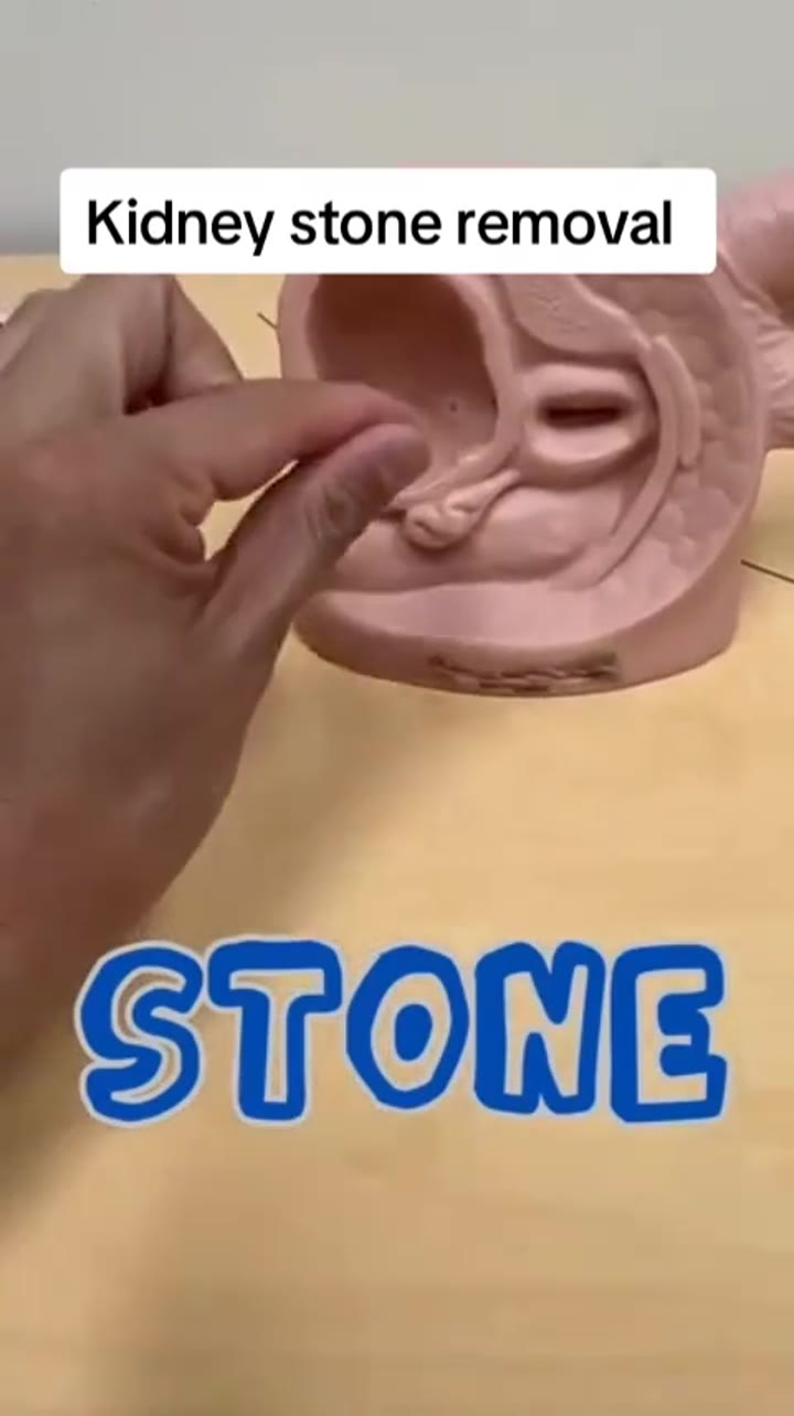 fyp fypシ viral tiktok pakistan medical kidneystone health