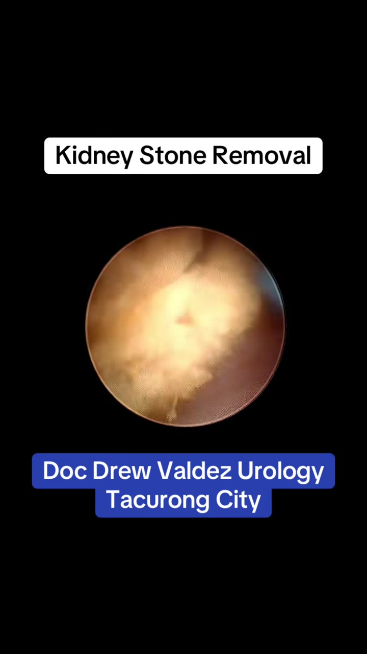 Kidney stone removal miniPCNL