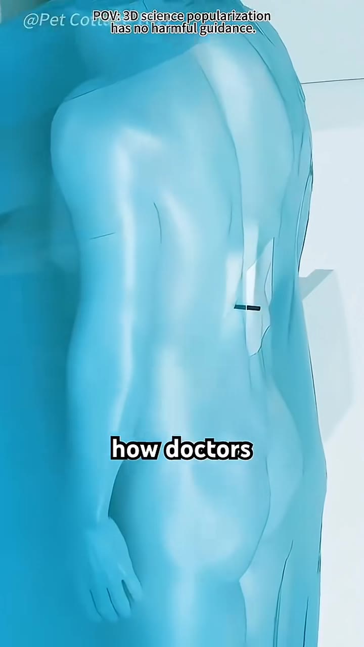Percutaneous Mephrolithotomy PCNL 3D Animation